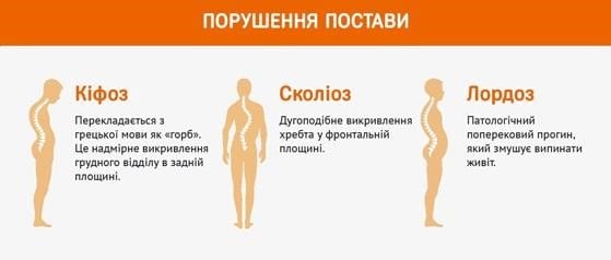 Лікування сколіозу Сколіоз