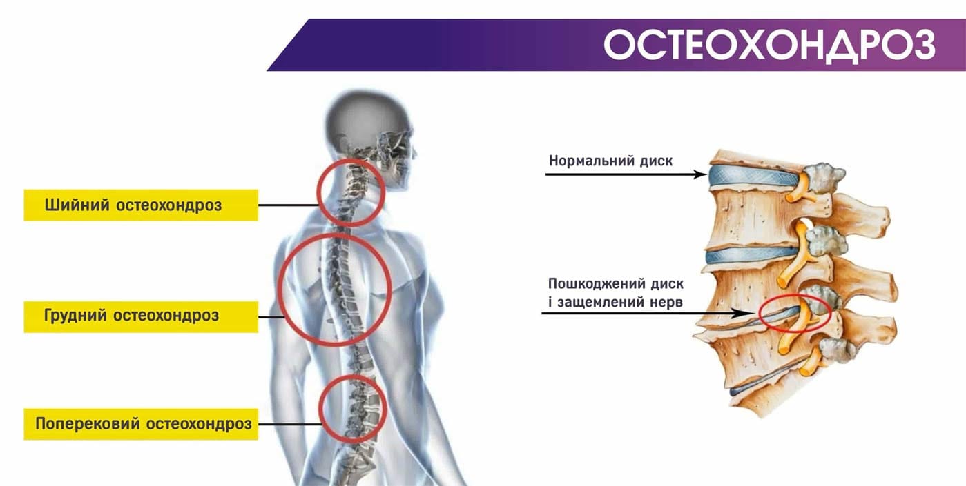 Як довго лікувати остеохондроз?